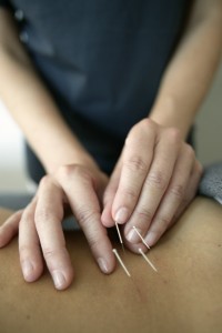 Woman receiving acupuncture --- Image by © Royalty-Free/Corbis